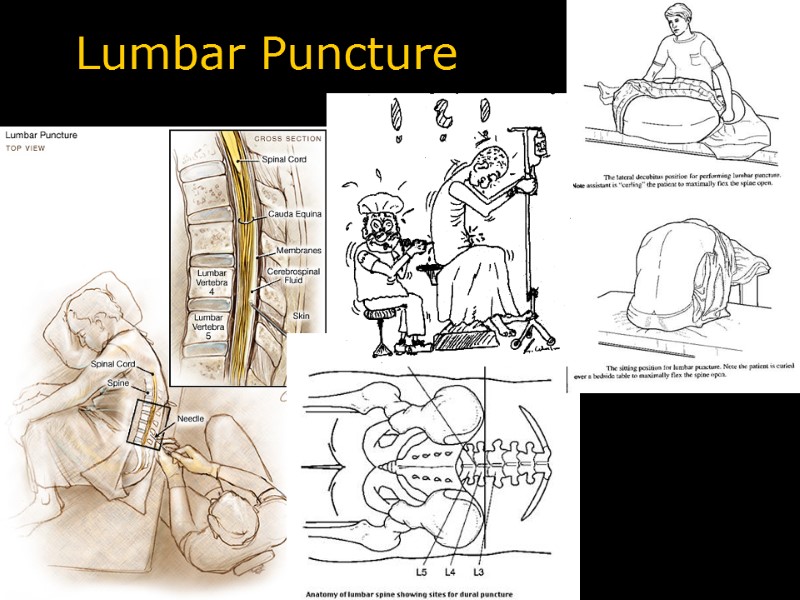 Lumbar Puncture